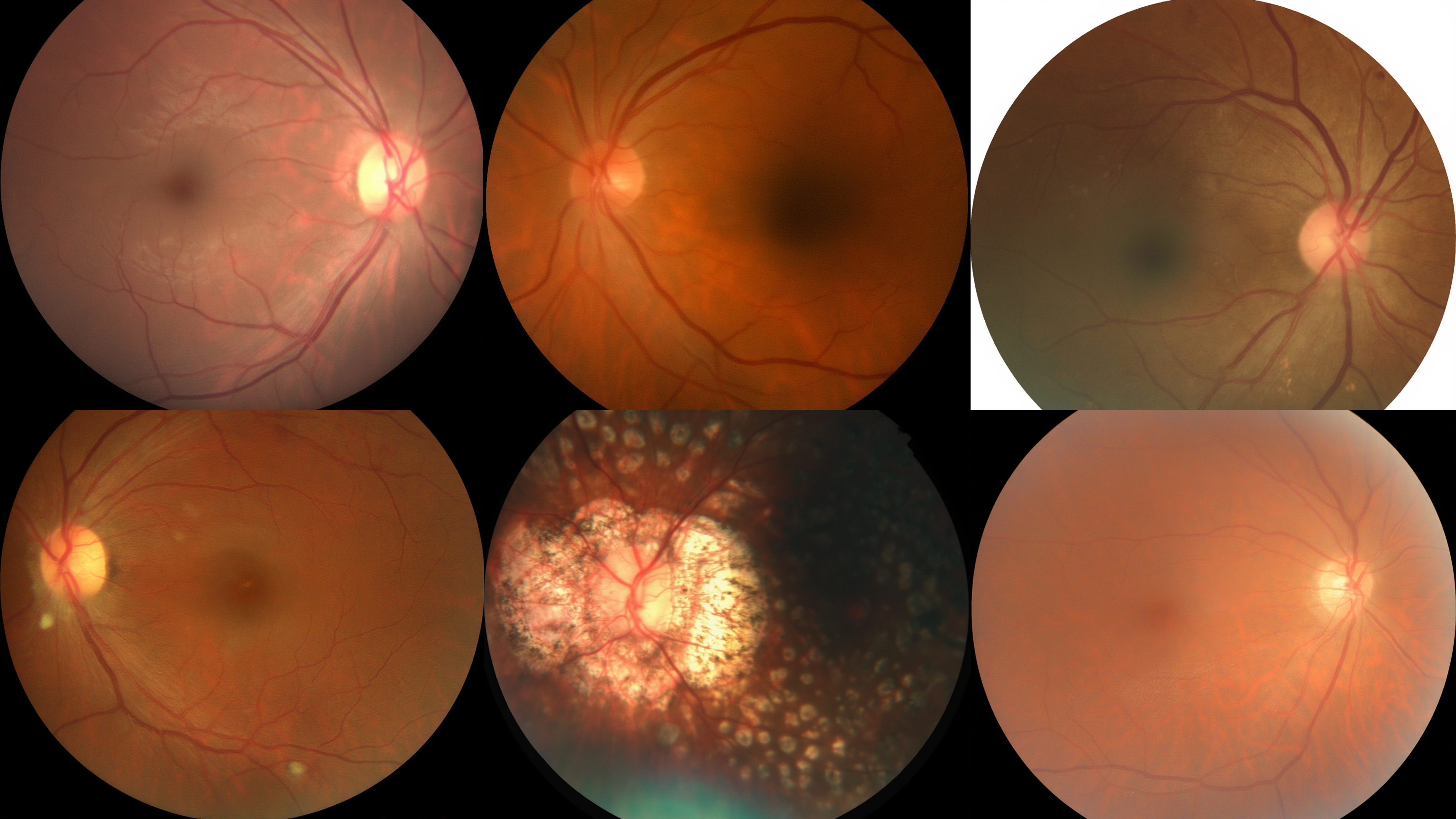 Retinal Fundus